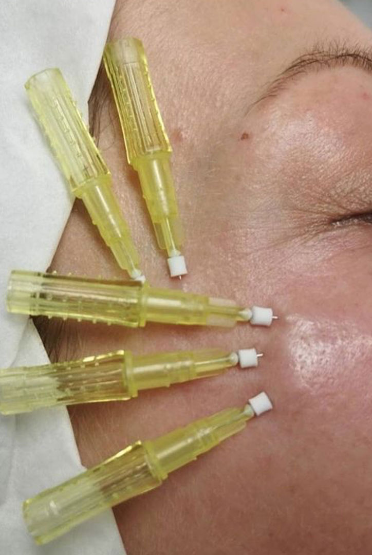 MEGA_3-SEMI-INVASIVE-PROCEDURES-YOU-SHOULD-KNOW-ABOUT-03 - MEGA